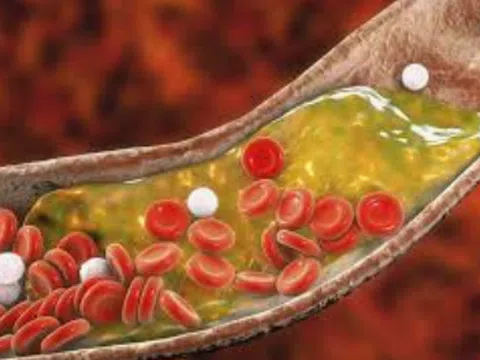 10 cách tự nhiên để giảm mức cholesterol của bạn