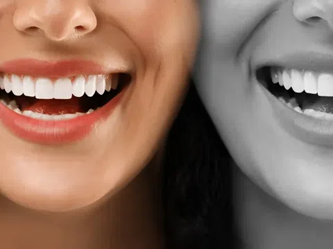 Tạm biệt vết ố: Những phương pháp làm trắng răng tự nhiên mà không làm hỏng men răng
